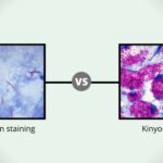 Comparison Between Kinyoun Stain vs Ziehl neelsen stain