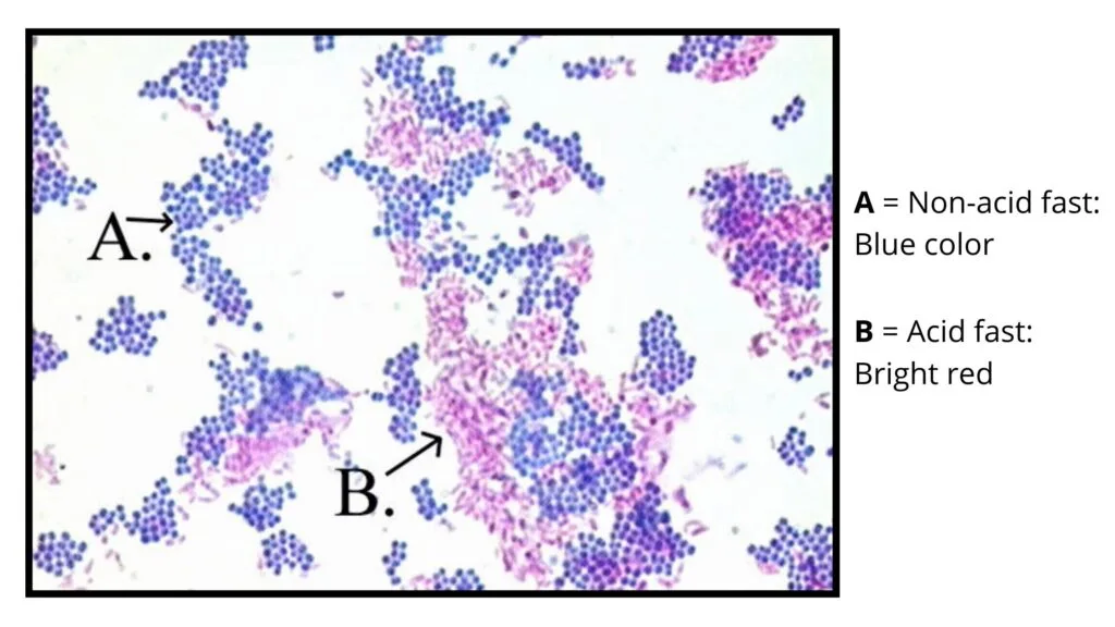 Ziehl Neelsen Stain Result