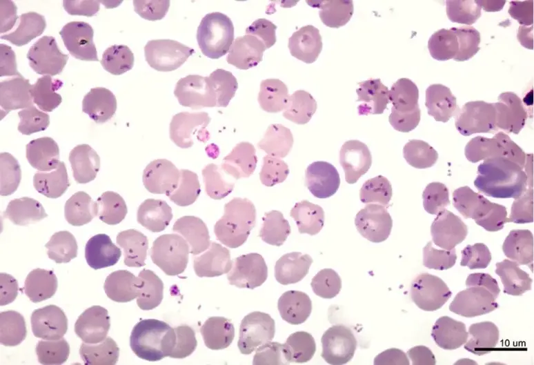 Picture of Giemsa-stained blood smear from a patient with Oroya fever, showing parasitism of all erythrocytes, with bacillary and coccoid forms of B. bacilliformis.
(Courtesy of P. Ventosilla and M. Montes, Universidad Peruana Cayetano Heredia, Lima, Peru)