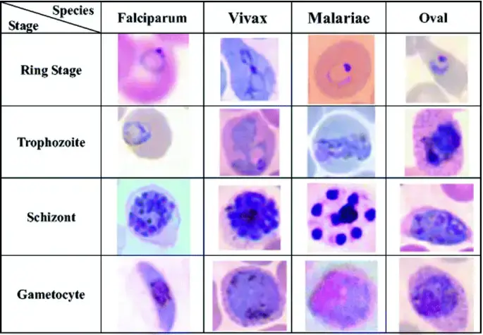 Photomicrograph of a Wright-Giemsa-stained peripheral blood smear illustrating several stages of Plasmodium species. 

