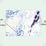 Toluidine blue stain of Mast cell