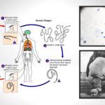 Lymphatic filariasis Wuchereria bancrofti