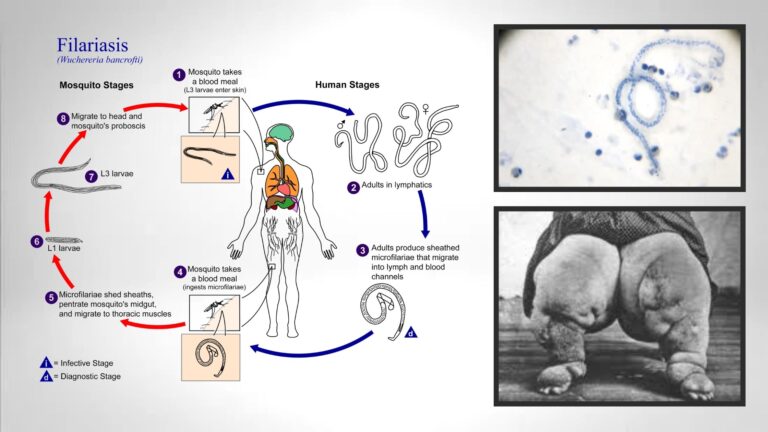 Lymphatic filariasis Wuchereria bancrofti