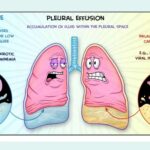 19 Differences Between Transudates and Exudates