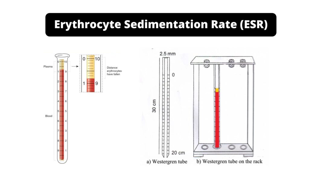 Erythrocyte Sedimentation Rate (ESR): Principle, Methods - Biology ...