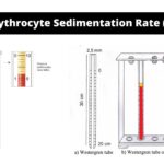 Erythrocyte Sedimentation Rate (ESR): Principle, Methods