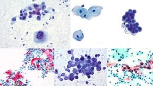 Papanicolaou Staining (Pap stain) – Principle, Procedure, Results, Applications