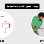 Differences between Diarrhea and Dysentery - Diarrhea vs Dysentery