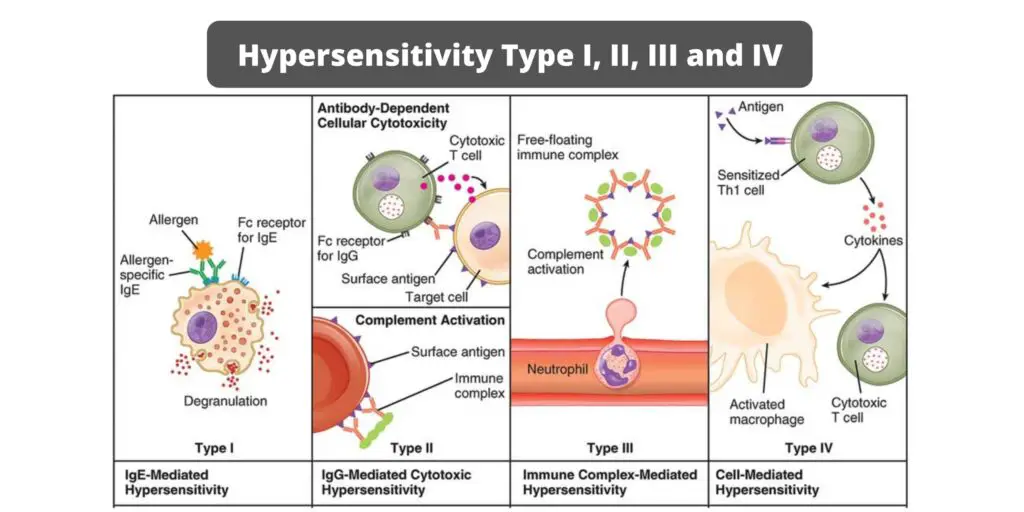 Hypersensitivity Type I, II, III and IV- Summary in table form ...