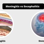 Differences between Meningitis and Encephalitis