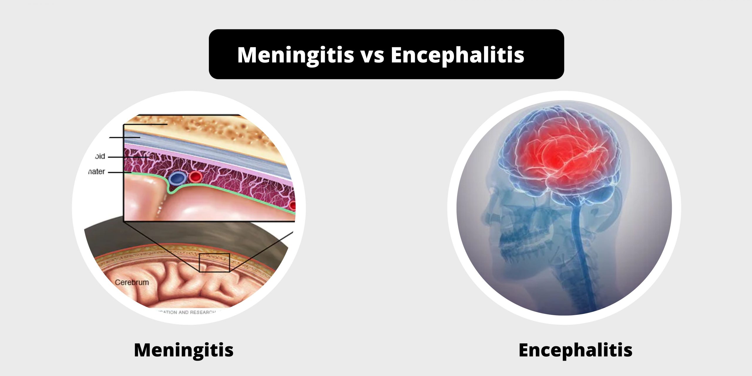 Differences between Meningitis and Encephalitis