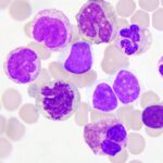 Total White Blood Cell (WBC) Count - Total Leucocyte Count (TLC)