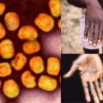 Monkeypox Virus - Pictures, Structure, Classification, Prevention, Treatment, Spread