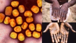 Monkeypox Virus – Pictures, Structure, Classification, Prevention, Treatment, Spread