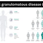 Chronic granulomatous disease (CGD) 