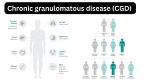 Chronic granulomatous disease (CGD) 