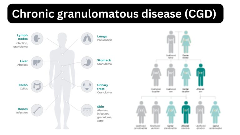 Chronic granulomatous disease (CGD) 