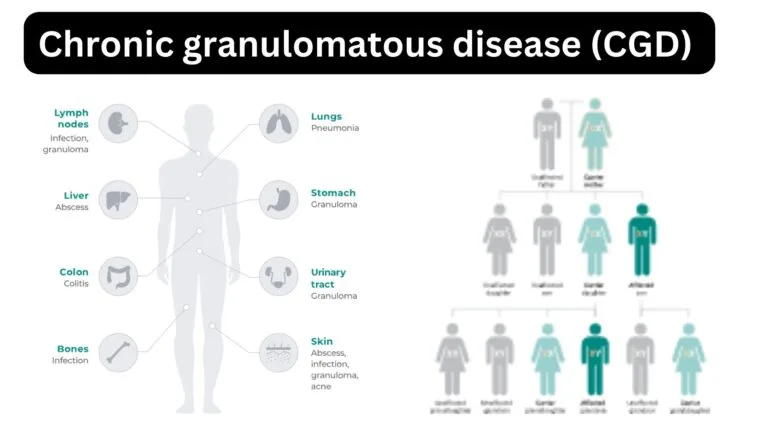 Chronic granulomatous disease (CGD) 