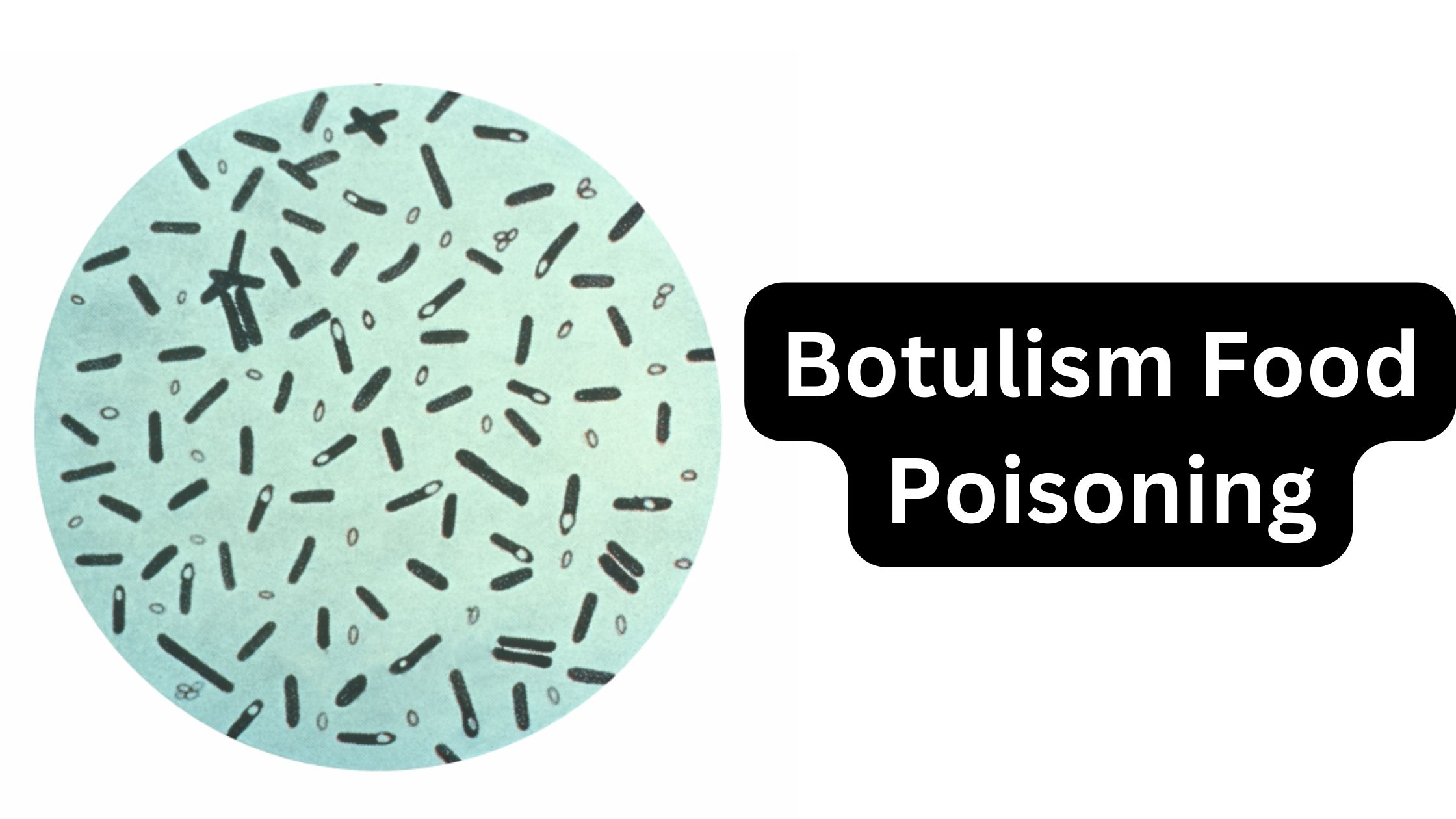 Botulism Food Poisoning by Clostridium botulinum