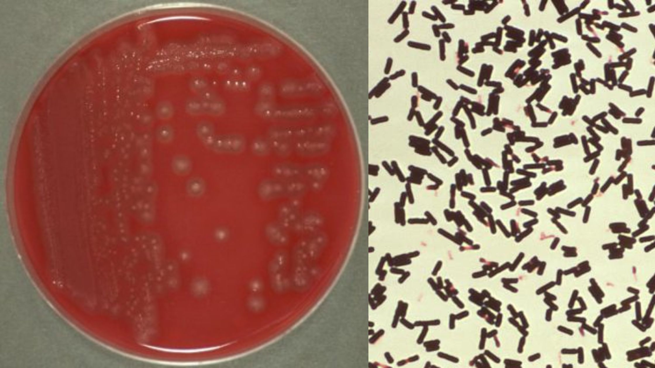 Clostridium Perfringens Food Poisoning