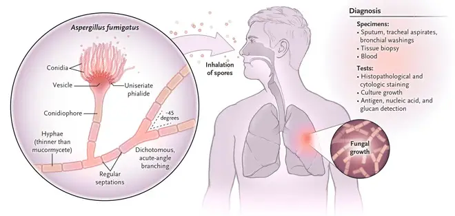 Aspergillosis - Causative Agent, Symptoms, Types, Treatment