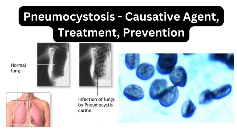 Pneumocystosis - Causative Agent, Treatment, Prevention