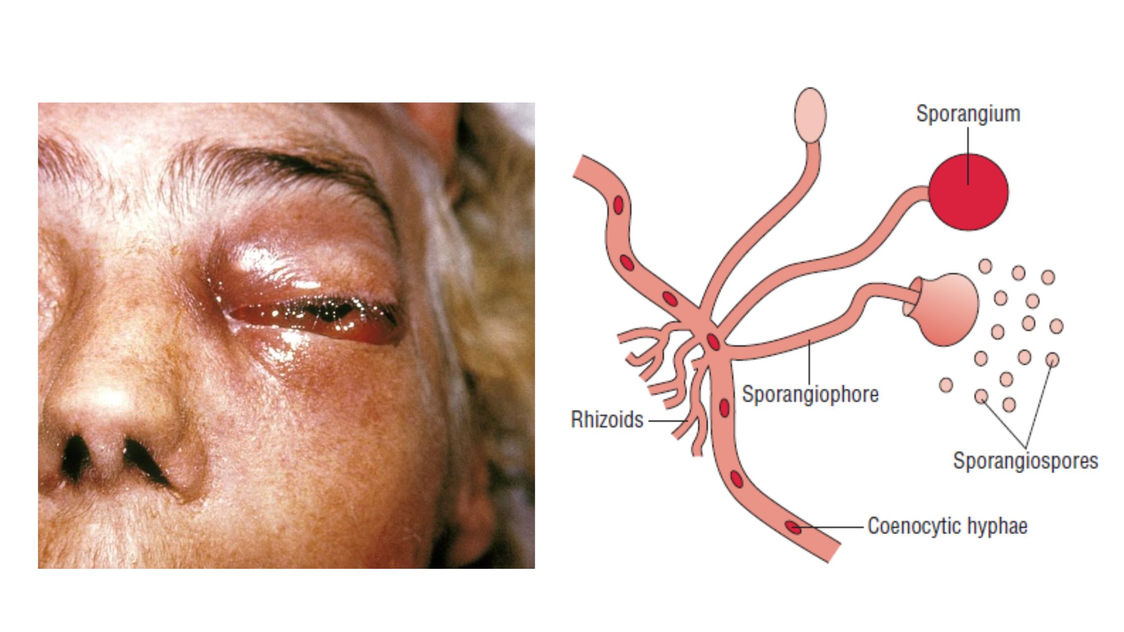 Zygomycosis (Mucormycosis) - Causative Agent, Symptoms, Prevention, Treatment