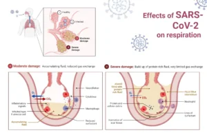 The progression of SARS-CoV-2 infection throughout the respiratory system