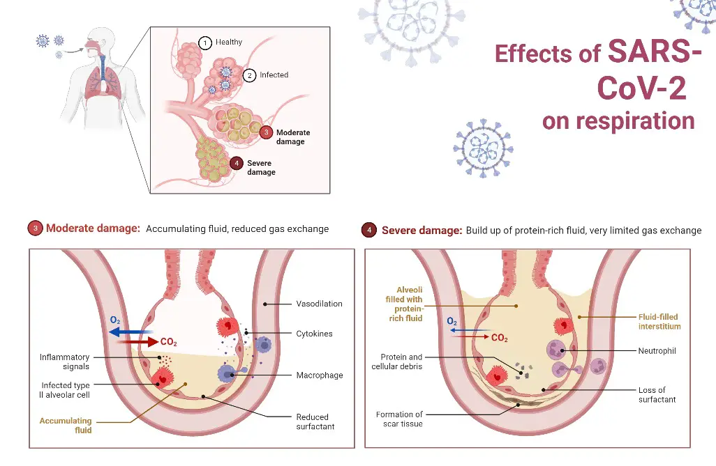 The progression of SARS-CoV-2 infection throughout the respiratory system