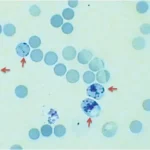 Reticulocyte Count : Principle, Procedure, Calculations and Clinical Significances