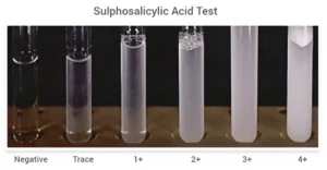 Sulphosalicylic Acid Test for Proteinuria – Principle, Procedure, Result, Uses