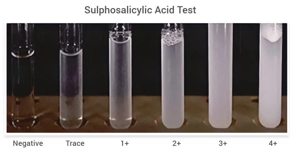 Sulphosalicylic Acid Test for Proteinuria - Principle, Procedure, Result, Uses