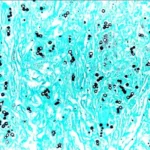 Results of Grocott-Gomori’s Methenamine Silver Staining