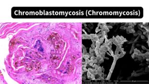 Chromoblastomycosis (Chromomycosis) – Morphology, Pathogenesis, Transmission, Treatment