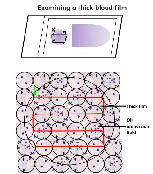 Examining the thick blood films
