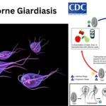 Foodborne Giardiasis - Definition, Pathogenesis, Contamination