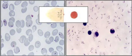 P. falciparum trophozoite stage in thick (right) and thin (left) smear.