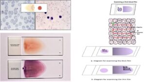 Thick and Thin Blood Smear for Malaria Diagnosis