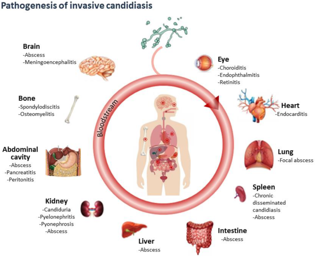 Candidiasis - Definition, Causative Agent, Types, Transmission ...