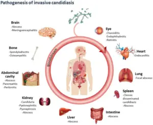 Candidiasis – Definition, Causative Agent, Types, Transmission
