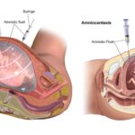 Amniocentesis (Amniotic Fluid Test) - Principle, Procedure, Result