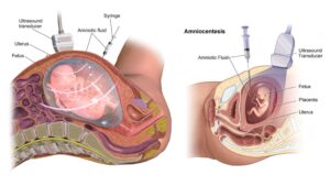 Amniocentesis (Amniotic Fluid Test) – Principle, Procedure, Result