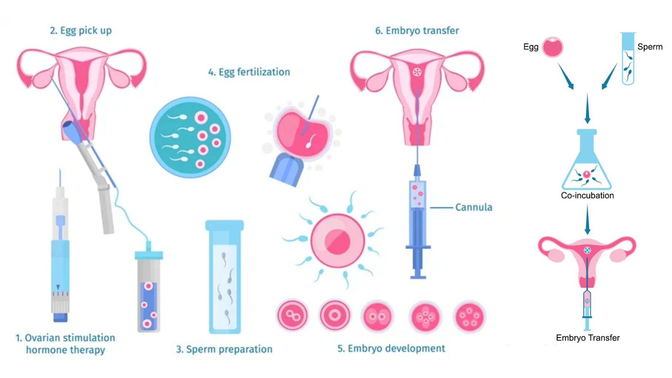 In Vitro Fertilization - Definition, Principle, Procedure, Applications