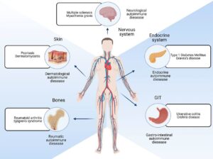 Autoimmune Disease – Definition, Types, Diagnosis, Treatment, Examples