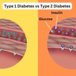 Type 1 Diabetes vs Type 2 Diabetes