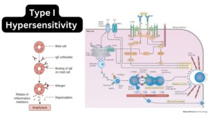 Type 1 (Anaphylactic) Hypersensitivity Reaction – Definition, Mechanism, Examples