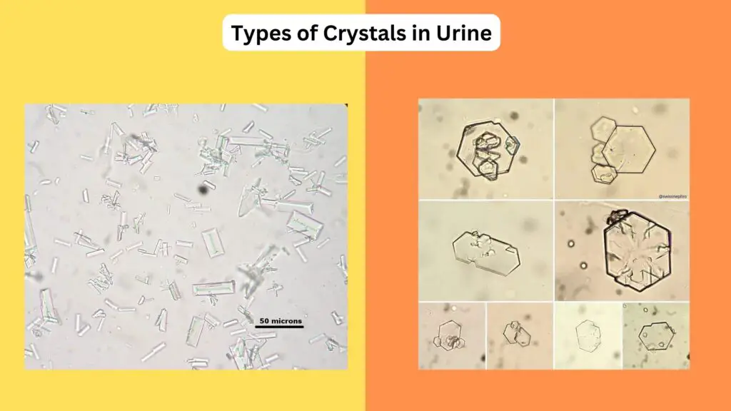 Types of Crystals in Urine - Causes, Factors, Identification - Biology ...