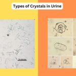 Types of Crystals in Urine