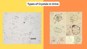 Types of Crystals in Urine – Causes, Factors, Identification