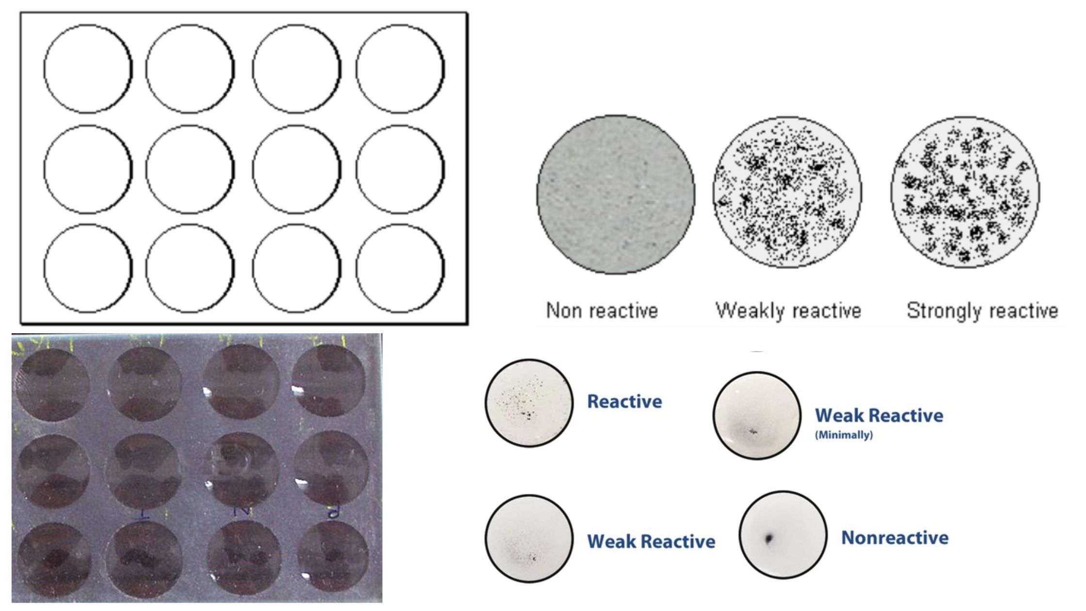 Venereal Disease Research Laboratory (VDRL) Test